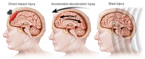 Results of US Military Research Using Interactive Metronome® to Treat ...